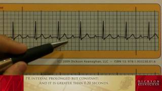 EKG Training An Introduction to Bradycardia  Heart Blocks Part 1 of 3 [upl. by Tolecnal]