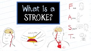 What is a Stroke HealthSketch [upl. by Allistir]