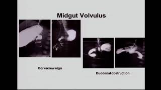 Ultrasound of the Vomiting Infant [upl. by Ebbarta112]