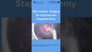 👂🔍 Dive into the World of Microscopic Surgery for Otosclerosis Stapedectomy at Dr Ram ENT Hospital [upl. by Eixela40]