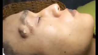 Pimple Popping amp Blackheads Removal 2 [upl. by Stedmann11]