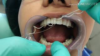 ORAL HYGIENE MAINTENANCE OF DENTAL VENEERS [upl. by Aihsem]