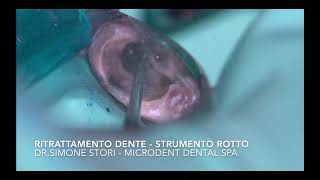 Endodonzia Bologna  Ritrattamento Canalare con Rimozione Strumento Rotto [upl. by Romito]