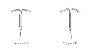 Intrauterine Devices  Copper and Hormonal Types Uses Characteristics Side effects [upl. by Hogarth]