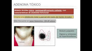 SESION CLÍNICA MIR PATOLOGÍA TIROIDEA EN ATENCIÓN PRIMARIA 2ª PARTE Enlace [upl. by Yenalem]