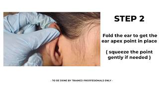 Blood letting Ear Apex  How to do  Ear Apex  Auricular Acupuncture Therapy [upl. by Neeoma]