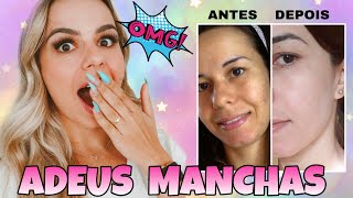 COMO CLAREAR MANCHAS NO ROSTO DE ACNE SOL E MELASMA  ANTES E DEPOIS [upl. by Roanne849]