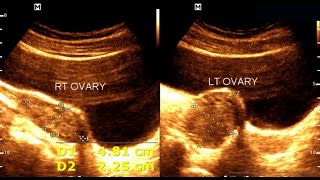 Chocolate Cyst  A Chocolate Cyst also known as Endometrioma [upl. by Durarte]