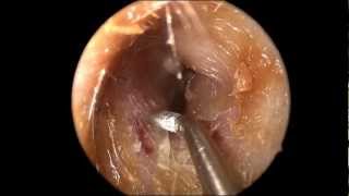 Ear Wax Cerumen Removal in HD [upl. by Duffie969]