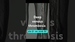 Deep venous thrombosismedicine healthtipshealth healthcaresymptoms treatmentvenous [upl. by Ewell]