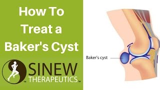 How To Treat a Baker’s Cyst and Speed Recovery [upl. by Romina49]