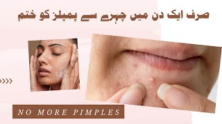 How to remove pimples naturally and permanently [upl. by Trill]