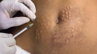 Addressing post pregnancy striae Alba Stretch mark [upl. by Sirovaj]