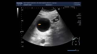 Hepatic Hydatid Cyst Two cases [upl. by Ahsieker]