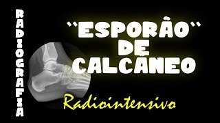 Esporão de calcâneoEntesopatia calcânea no RX [upl. by Olnee]