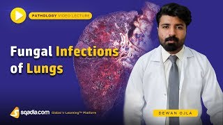 Fungal Infections of Lungs  Pathology Lectures  Medical Education Videos  VLearning [upl. by Dohsar557]