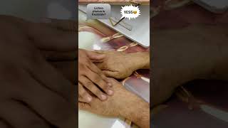 Lichen planus treatment [upl. by Ahsha346]