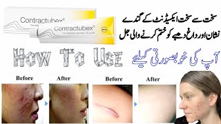 contractubex  contractubex gel  contractubex gel how to use  contractubex gel for acne scars [upl. by Winters581]