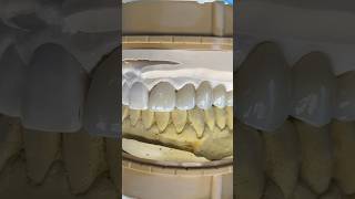 Splinted Pontic Bridge dental teeth dental smile lsk121shorts shortvideo shorts [upl. by Eihcir943]