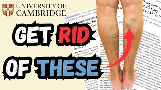 How to BOOST Your Leg CIRCULATION and Get RID of Varicose Veins NATURALLY Cambridge Doctor Explains [upl. by Akirdna]