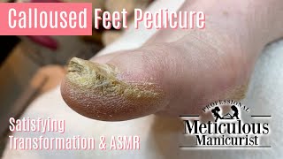 How to Pedicure Extremely Calloused Feet and Toes ASMR [upl. by Neibaf]