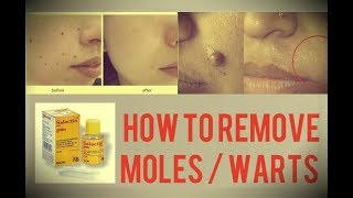 SALACTIN PAINT Usage  Salicylic Acid  Removal OF Moles amp Warts  2017 [upl. by Linette]