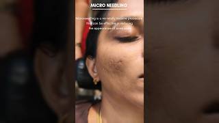 microneedling for scar removal Zeyz Womens Exclusive Salon sholinganallur Chennai 6381281851 [upl. by Kassie]