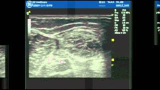 Ultrasound Guided ankle block part 1 [upl. by Anirbed]