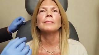 Dr Samuel Baharestani Performs Live Lip Filler Injections  Restylane Refyne [upl. by Ardelis]