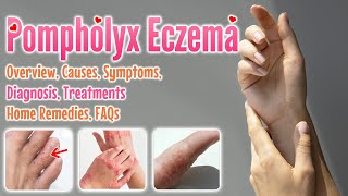 Pompholyx eczema causes symptoms diagnosis treatment home remedies FAQ  Dyshidrotic eczema [upl. by Rebba]