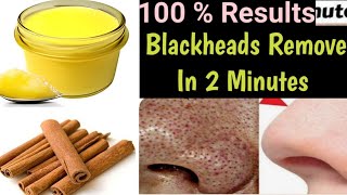 How To Remove Blackheads At Home  Permanent Blackheads Removal Pack  100 Natural diy Skincare [upl. by Gilbertson305]