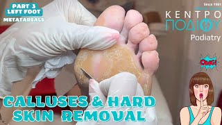 Part 3 Calluses amp Hard Skin Removal feet κεντροποδιου foot podologos podiatrist corn footcare [upl. by Adlev362]