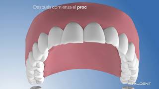 Estética Dental  Contorneado  Vitaldent [upl. by Arleyne]