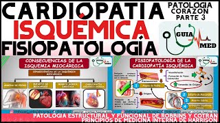 CARDIOPATÍA ISQUÉMICA FISIOPATOLOGÍA  GuiaMed [upl. by Aryaz686]