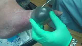 Wound Vac Application performed by Dr Dominick Sansone [upl. by Grieve]