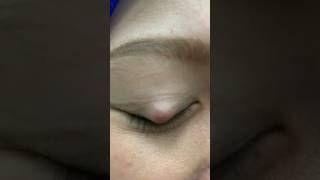 CHALAZION vs KETUMBIT TIPS RAWATAN  DrMan Ttdi Story [upl. by Abekam754]