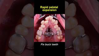 Expand upper teeth with rapid palatal expander braces orthodontist dentist [upl. by Cherie]