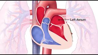 Mitral Valve Regurgitation [upl. by Enrichetta862]