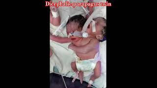 Neonatal Cases  Rare conjoined twins with two heads one body Dicephalic parapagus twin neonate [upl. by Vidovic961]