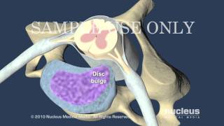 Cervical Disc Herniation [upl. by Iphlgenia]