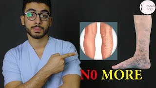 ما هى دوالى الساقين ؟  علاج مشكلة الدوالى نهائيا varicose veins treatment [upl. by Eikcid]