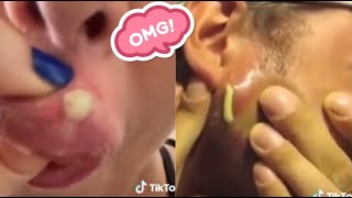 Satisfying Blackhead Removal Compilation  Best Techniques for Clear Skin [upl. by Akili]