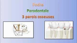 Les poches en parodontologie  Pocket in periodontology [upl. by Clementi]