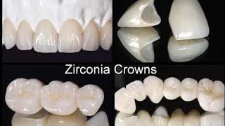 Reaction after transformation from PFM to Zirconia Crowns [upl. by Mushro28]