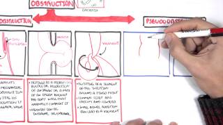 Bowel Obstruction  Causes and Pathophysiology [upl. by Attesoj]