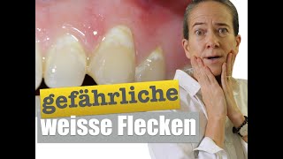 FLECKEN auf ZÄHNEN die schockierende Wahrheit [upl. by Yeldah]