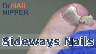 Sideways Toenails Fungal Nails FEETure Friday 2022 [upl. by Danaher]