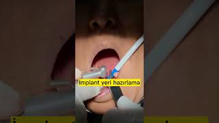 Diş çekimleri ve anında implant uygulamasıTeeth extraction immediate implant surgery [upl. by Eadie445]