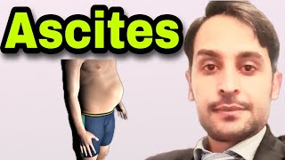 Ascites  Causes  Symptoms  Diagnosis  Treatment [upl. by Indihar68]