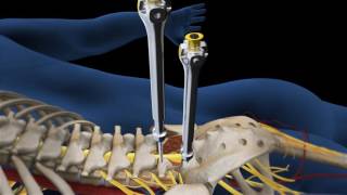 Lumbar Fusion of L5 S1 Animation [upl. by Nolek]